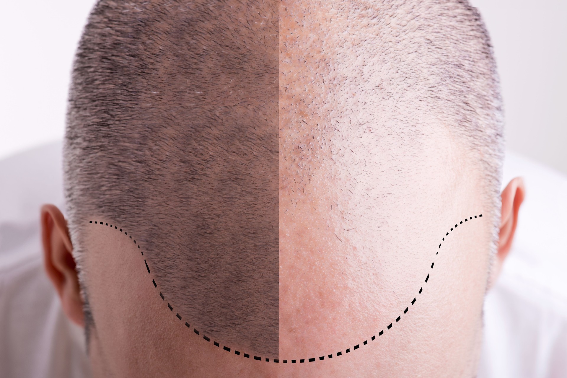 Hair Loss - Before and After hair transplant male pattern baldness