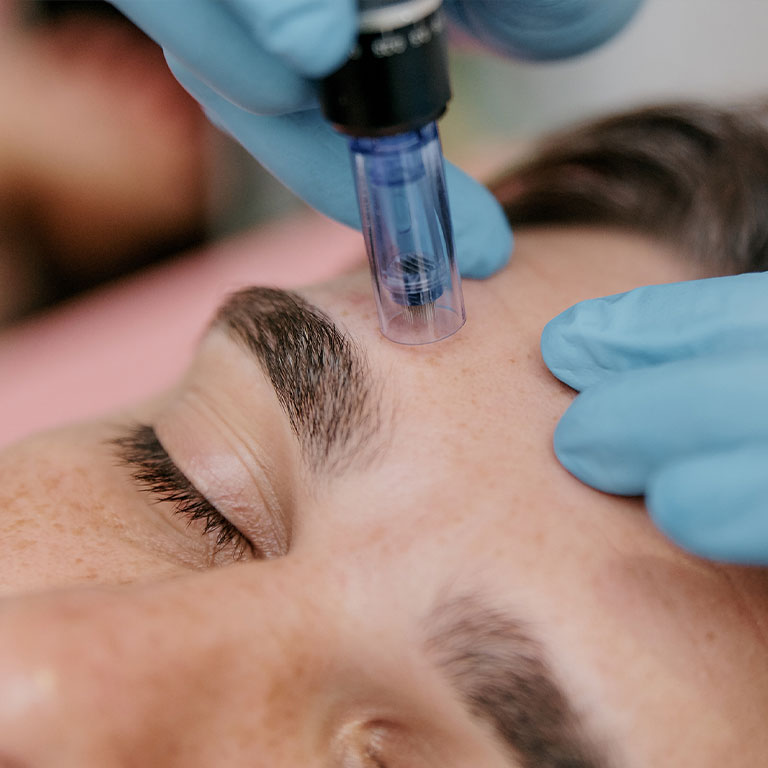 Person receiving microneedling treatment on forehead.
