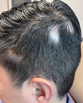 A man's head showing partial hair loss on the scalp.