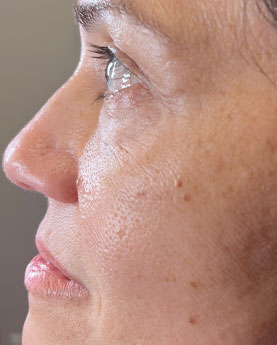 Profile view of a person's face with visible skin texture.