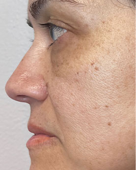 Profile view of a woman's face showing skin texture and complexion.