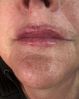 Close-up of a person's lips and lower face with glossy lipstick.