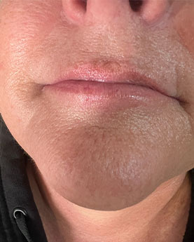 Close-up of a person's lips and chin showing detailed skin texture.